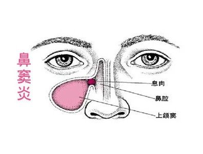 慢性鼻窦炎患者，可能会有4个表现..鼻炎怎么护理好得快鼻炎吃什么好 六款